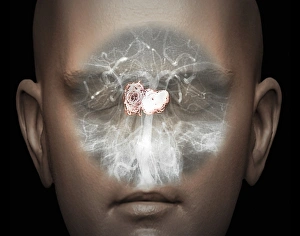 Aneurysm treatment, angiogram C018/0514 Aneurysm treatment, angiogram C018/0514