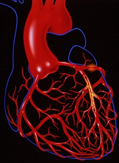 Angina pectoris Angina pectoris