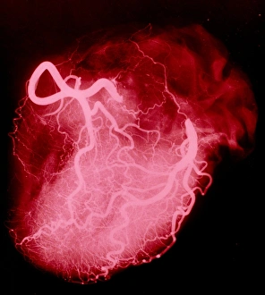 Arteriograph of the coronary arteries of the heart Arteriograph of the coronary arteries of the heart