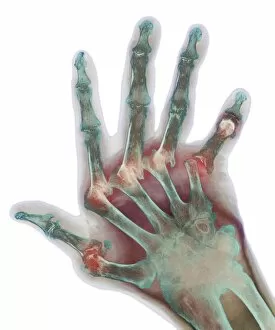 Images Dated 4th September 2002: Arthritic hand, X-ray