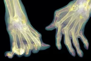 Images Dated 4th September 2002: Arthritic hands, X-ray