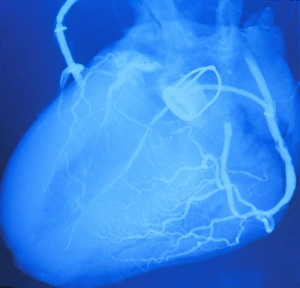 Artificial heart valve Artificial heart valve