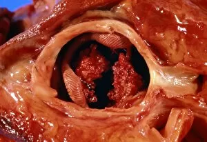 Images Dated 15th April 2003: Artificial heart valve showing bacterial infection