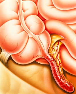 Images Dated 2012 April: Appendix with inflamed appendix Print