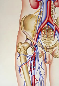 Artwork of deep vein thrombosis and bones in leg Artwork of deep vein thrombosis and bones in leg