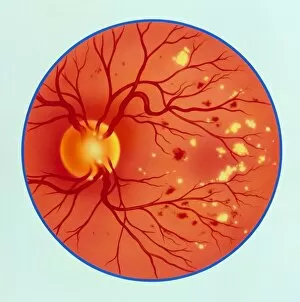 Images Dated 24th February 1995: Artwork of diabetic retinopathy ophthalmoscope view