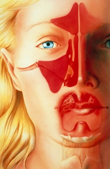 Artwork of facial sinuses & tonsils (sinusitis) Artwork of facial sinuses & tonsils (sinusitis)