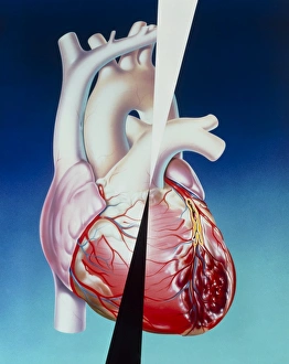 Artwork of heart attack due to atherosclerosis Artwork of heart attack due to atherosclerosis
