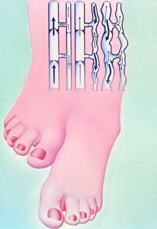 Artwork of legs with healthy and varicose veins Artwork of legs with healthy and varicose veins