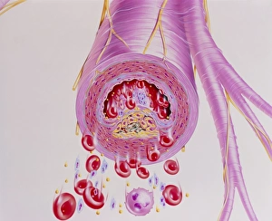 Artwork of narrowed artery by atherosclerosis Artwork of narrowed artery by atherosclerosis