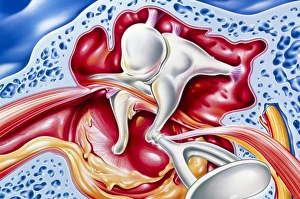 Artwork of otitis media middle ear infection Artwork of otitis media middle ear infection