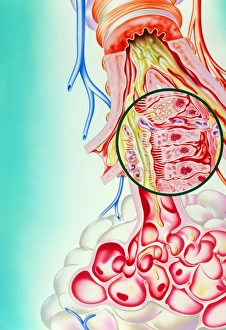 Artwork of the respiratory system of an asthmatic Artwork of the respiratory system of an asthmatic