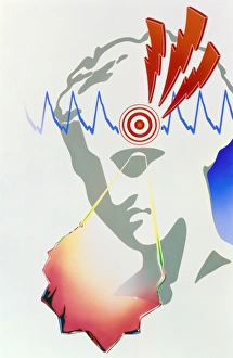 Artwork of scotoma visual disturbance in migraine Artwork of scotoma visual disturbance in migraine