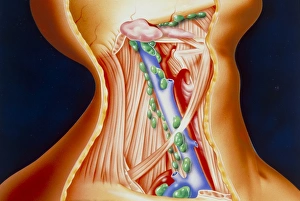 Artwork showing lymph nodes in the neck Artwork showing lymph nodes in the neck