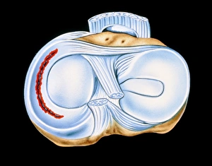 Artwork of torn knee cartilage in sports injury Artwork of torn knee cartilage in sports injury