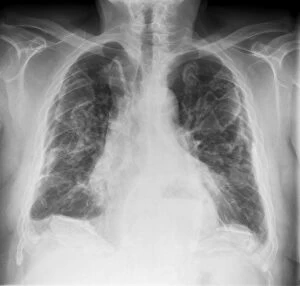 Asbestosis, X-ray C017 / 7143