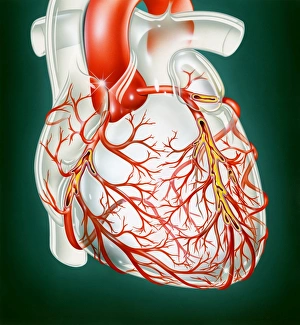 Atherosclerosis Atherosclerosis