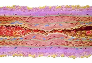 Cholesterol Collection: Atherosclerosis in artery, artwork C016 / 6571