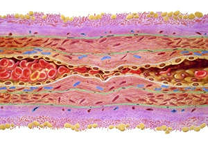 Atherosclerosis in artery, artwork C016/6571 Atherosclerosis in artery, artwork C016/6571