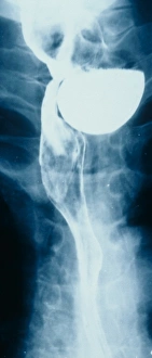 Bariium swallow x-ray showing weakness in muscle Bariium swallow x-ray showing weakness in muscle