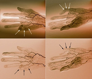 Blood supply of the hand, angiograms C018/0389 Blood supply of the hand, angiograms C018/0389