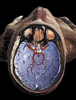 Brain blood supply, MRI scan C018/0432 Brain blood supply, MRI scan C018/0432