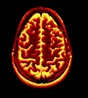 Brain scan, MRI scan, heightmap F006/7081 Brain scan, MRI scan, heightmap F006/7081