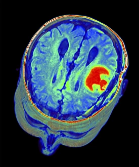Central Nervous System Gallery: Brain tumour, 3D-MRI scan