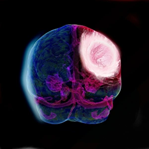 Central Nervous System Gallery: Brain tumour, DTI modelling C017 / 7060