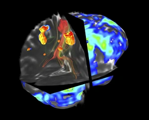 Central Nervous System Gallery: Brain tumour, fMRI and tractography C017 / 7102