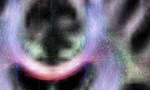 Central Nervous System Gallery: Brains white matter, DTI MRI scan
