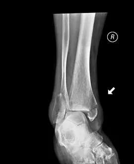 Xray Collection: Broken ankle, X-ray C017 / 7185