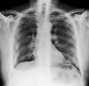 Xray Collection: Broken ribs, X-ray C017 / 7566