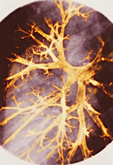 Bronchitis, X-ray Bronchitis, X-ray