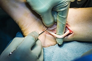 Cavus foot surgery, ankle tendons Cavus foot surgery, ankle tendons