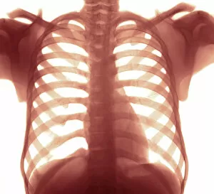 Chest X-ray of a healhty human heart