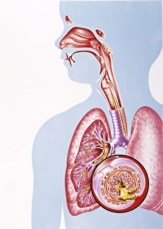 Childhood asthma Childhood asthma