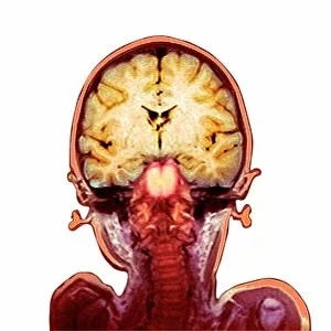 Nervous System Gallery: Childs brain, MRI scan