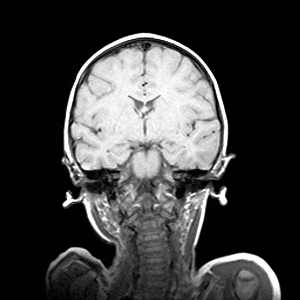 Childs brain, MRI scan