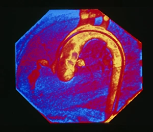 Colour X-ray: coronary artery in Kawasaki disease Colour X-ray: coronary artery in Kawasaki disease