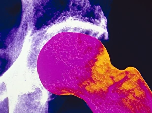 colour X-ray of upper femur with osteoporosis colour X-ray of upper femur with osteoporosis