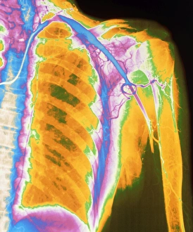Coloured angiogram of embolus blocking arm artery Coloured angiogram of embolus blocking arm artery