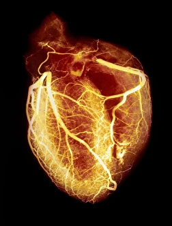 Coloured arteriogram of arteries of healthy heart Coloured arteriogram of arteries of healthy heart