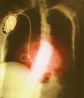Coloured chest X-ray showing heart pacemaker Coloured chest X-ray showing heart pacemaker