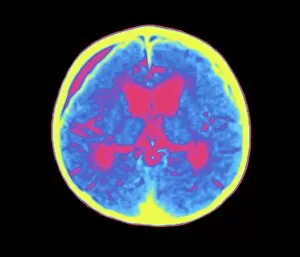 Images Dated 4th November 1999: Coloured MRI brain scan of abscess in meningitis