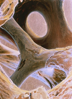 Coloured SEM of cancellous (spongy) bone tissue Coloured SEM of cancellous (spongy) bone tissue
