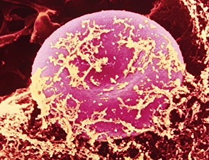 Coloured SEM of red blood cell covered in fibrin Coloured SEM of red blood cell covered in fibrin