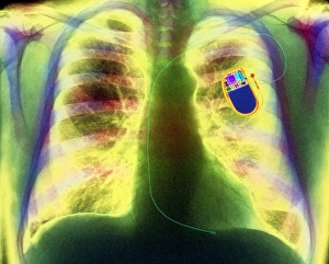 Coloured X-ray of chest showing heart pacemaker Coloured X-ray of chest showing heart pacemaker