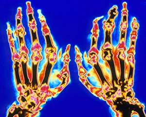 Coloured X-ray of hand in gouty arthritis Coloured X-ray of hand in gouty arthritis