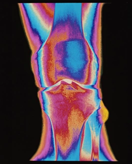 Coloured X-ray of a human knee joint (front view) Coloured X-ray of a human knee joint (front view)